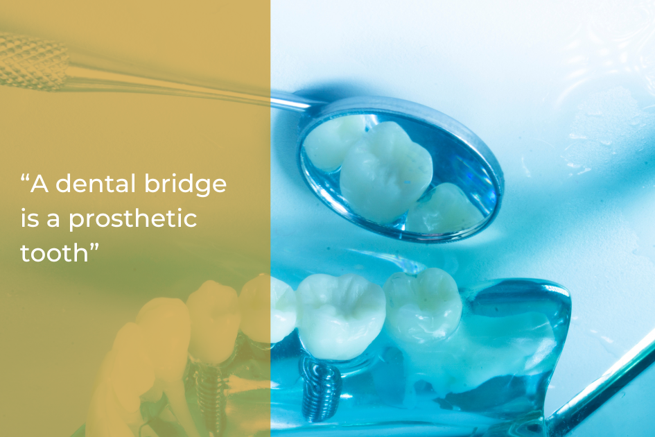 A dental mirror reflects prosthetic teeth beside a model with dental implants and bridges; text reads, “Discover the difference: a dental bridge is a prosthetic tooth.”.