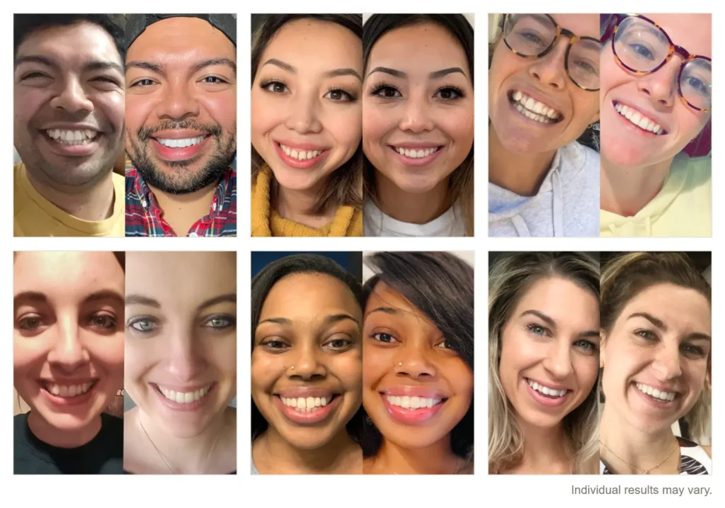 CandidPro clear aligner before-and-after results at Main Street Dental